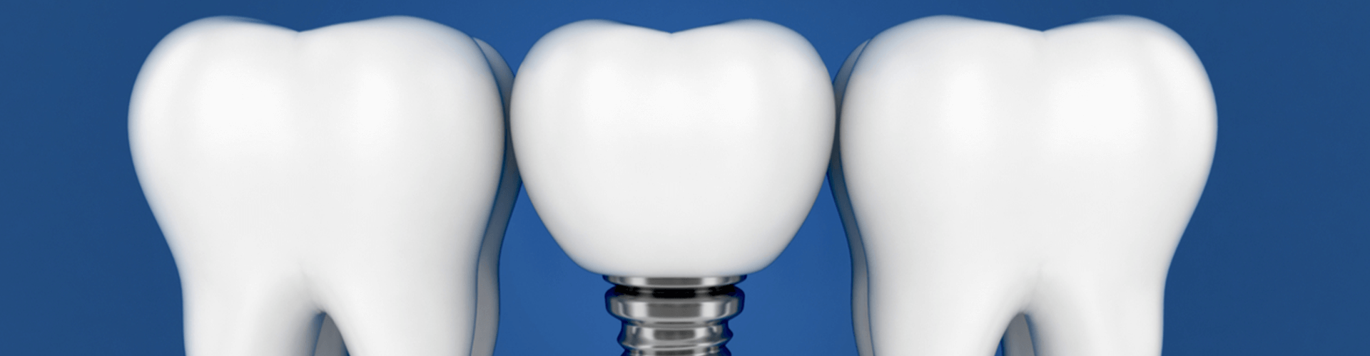 rendering of a dental implant between teeth